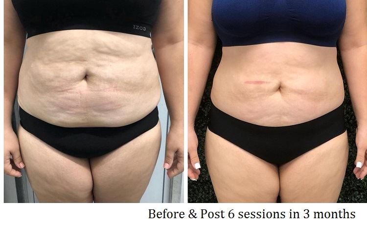 Cellulite Before Afte 1