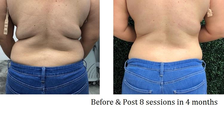 Body Shaping Before After 3