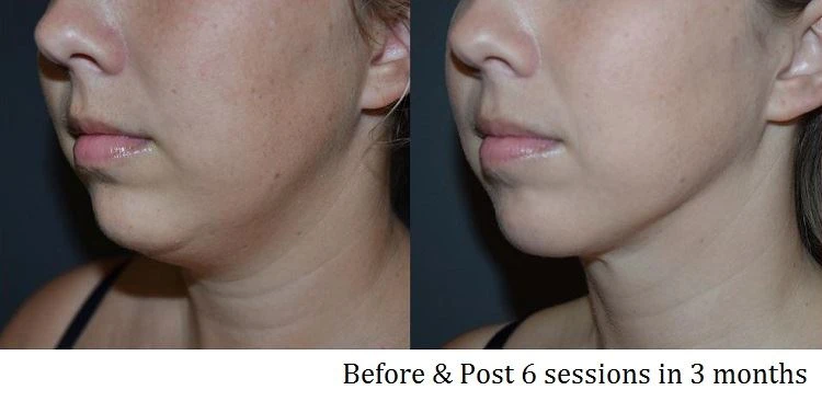 Face neck Before After 1