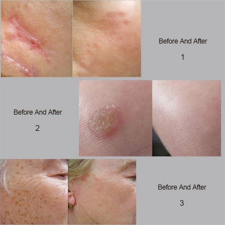 Hot Sale Fractional CO2 Laser Vagina Tightening Machine